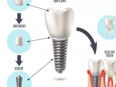 Dental Crowns Ahmedabad