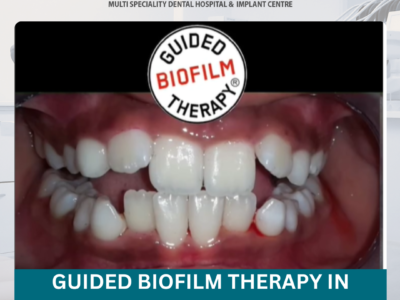 Guided Biofilm Therapy in Hyderabad