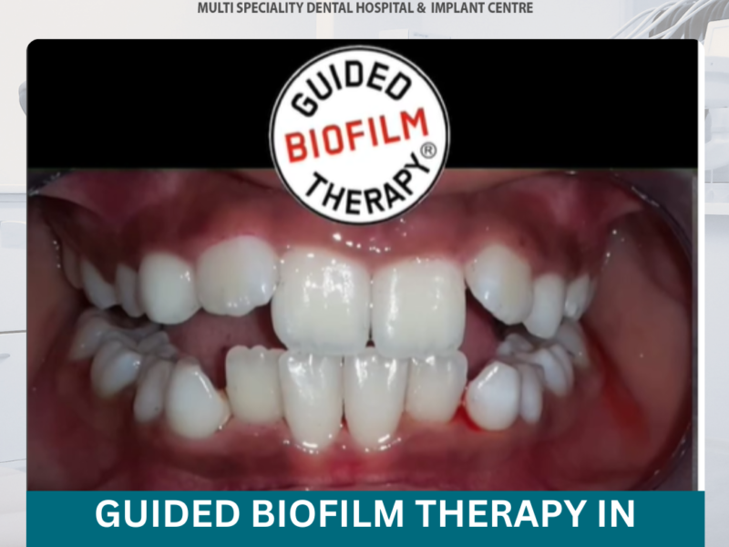 Guided Biofilm Therapy in Hyderabad