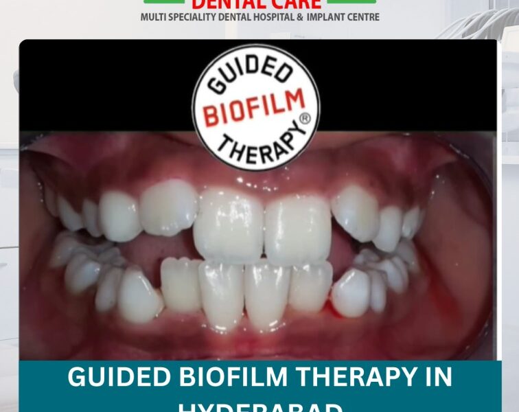 Affordable Guided Biofilm Therapy Cost in Hyderabad – Modern Dental Cleaning Solution