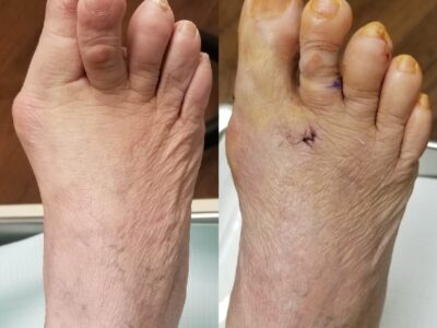 Bunion Surgery New Brunswick