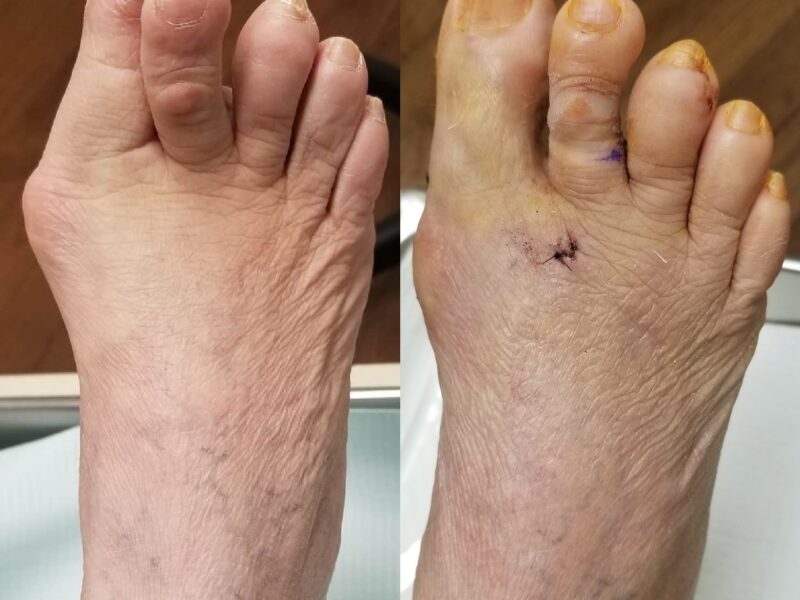 Bunion Surgery New Brunswick