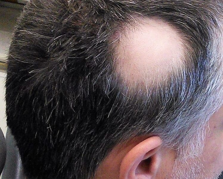 Skull Tec Scalp Micropigmentation